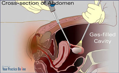 abdominal cancer laparoscopy)